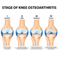Diagram showing the stages of knee osteoarthritis from doubtful to severe.