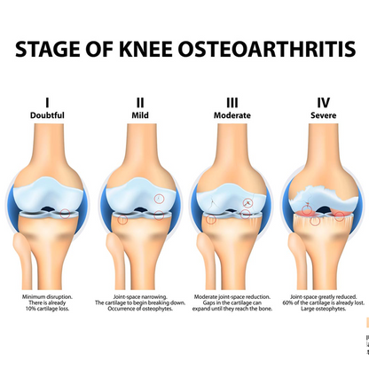 Diagram showing the stages of knee osteoarthritis from doubtful to severe.