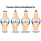 Diagram showing the stages of knee osteoarthritis from doubtful to severe.