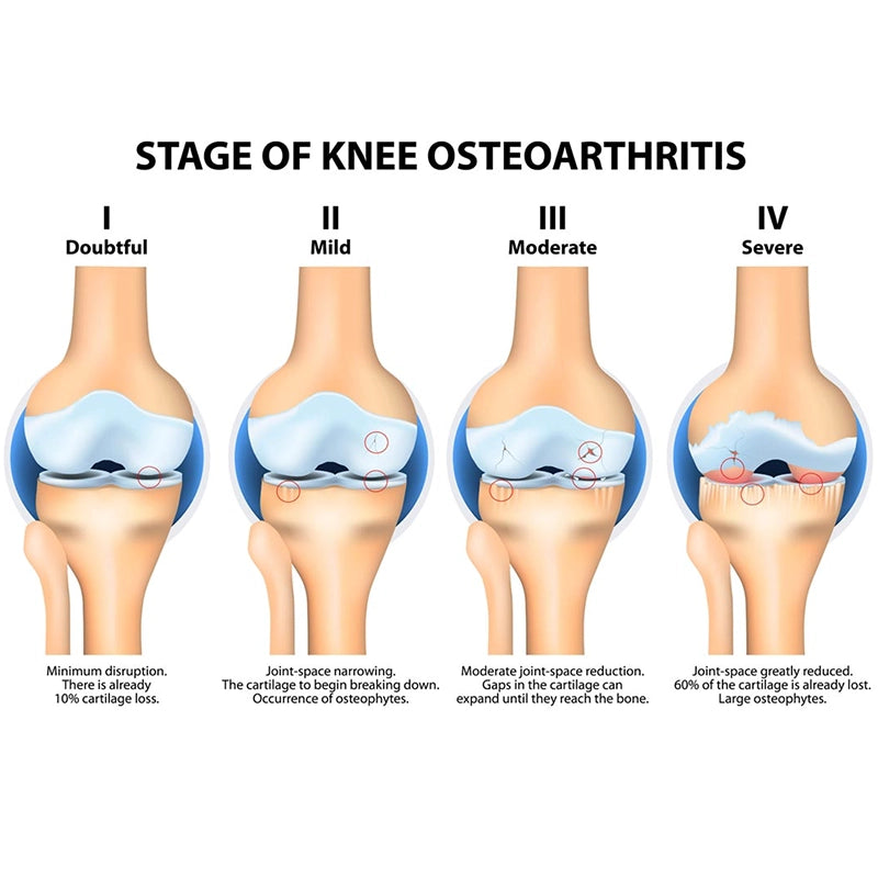 Diagram showing the stages of knee osteoarthritis from doubtful to severe.