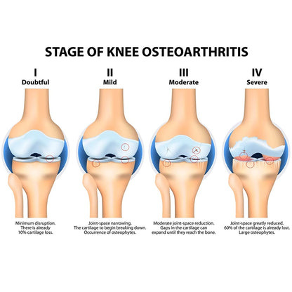 Diagram showing the stages of knee osteoarthritis from doubtful to severe.